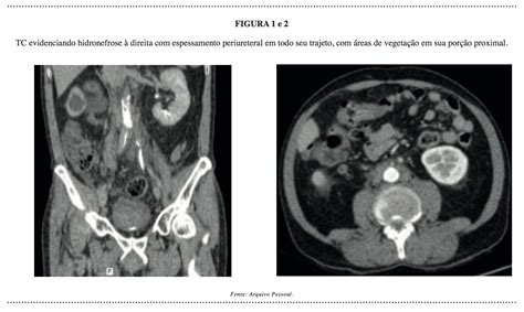 O que é carcinoma urotelial de alto grau?